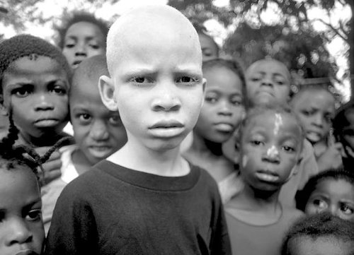 Bambino albino africano